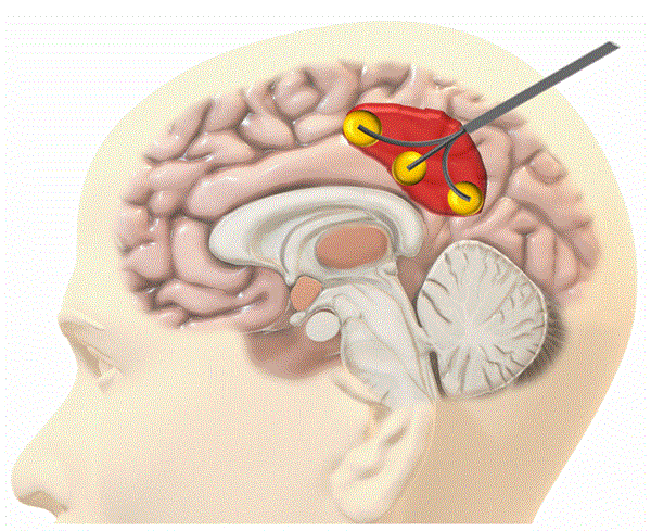 Conceptual illustration of multi-site ablation 